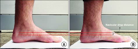 navicular drop test|navicular drop test article.